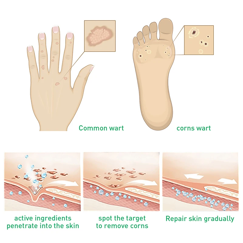 10ml Remove Foot Corn Care Cream Remove Foot Calluses Remove Warts