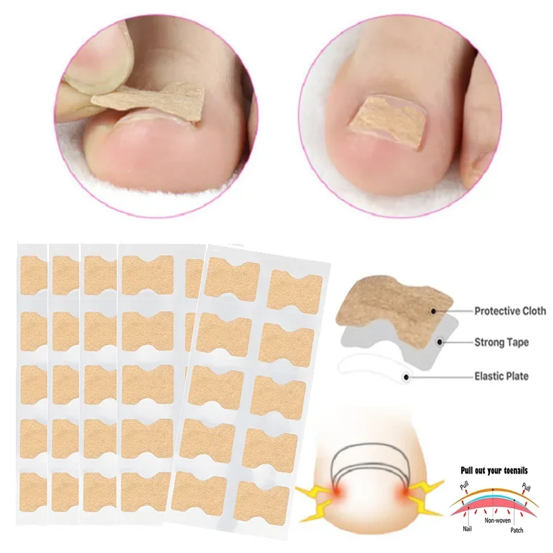 10pcs Ingrown Toenail Correction Tool Ingrown Toe Nail Treatment Elastic Patch Sticker Straightening Clip Brace Pedicure Tool