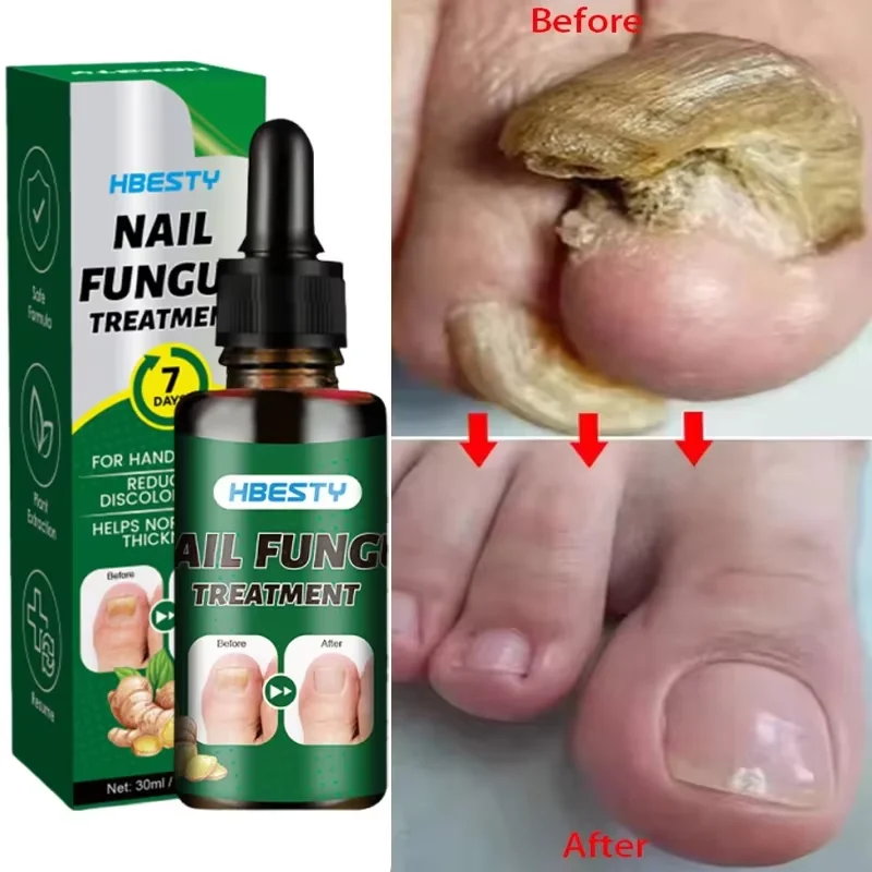 7Days Nail Fungus Treatment Serum Ginger Anti-infective Paronychia Onychomycosis Toe Foot Nail Fungal Repair Gel Hand Foot Care nail fungus treatment
