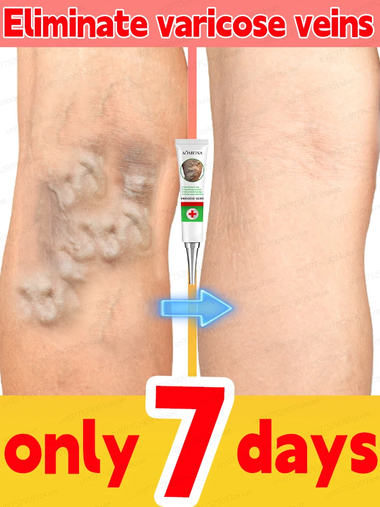 

Varicose vein ointment, repair varicose veins and vasculitis in 7 days