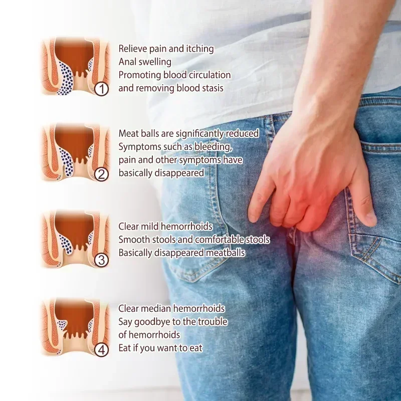 Hemorrhoid Removal Cream New Natural Herbal Extract Relieve Anal Anus Swelling Bleeding Gel