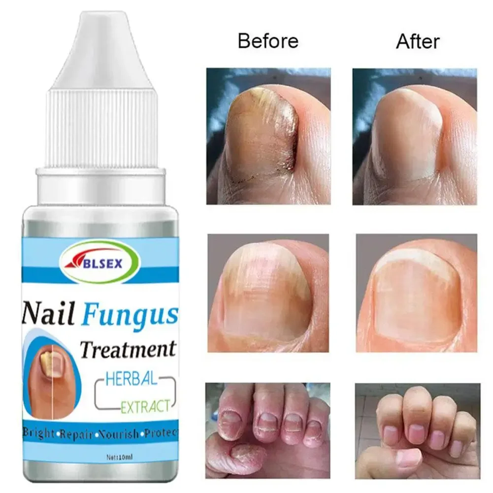 

Fungus Nails Treatment for Fingernails Toenails Repair Onychomycosis Paronychia Anti Infection Toe Nail Fungal Removal Liquid