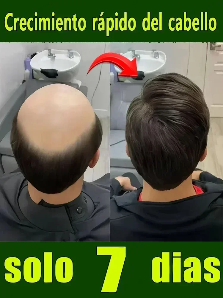 99% of buyers buy again, have more and more hair, say goodbye to baldness, thick hair,Hot selling product