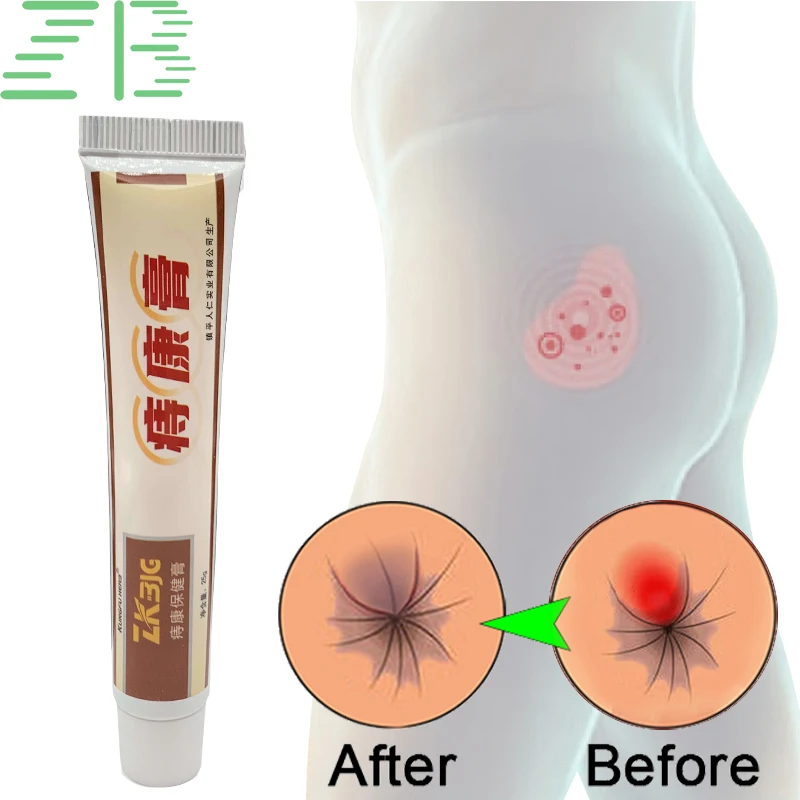 20g Hemorrhoid ointment for the treatment of internal hemorrhoids, hemostasis, anti-inflammatory, anti infection, and healing