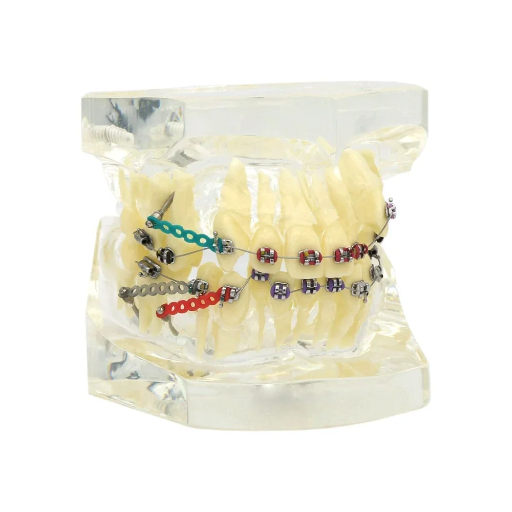 dental-orthodontics-treatment-teeth-model-with-metal-brackets-arch-wires-ties-for-demonstratemodel-teeth-dentistry