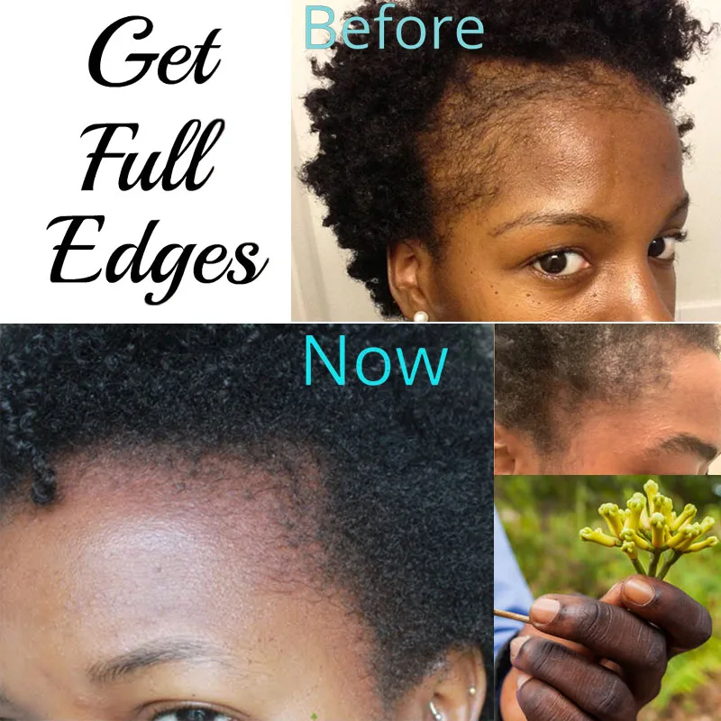 Hair Oils Solutions for Traction Alopecia Ayurvedic Herbs and Powders for Natural Hair Growth Clove The Secret To Grow Edge Back