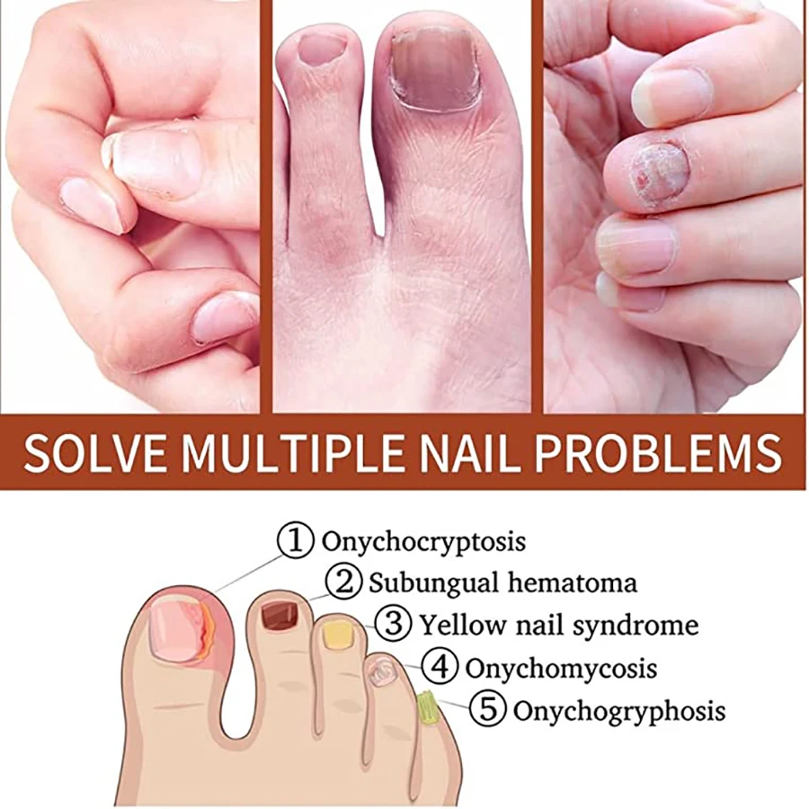 How To Prevent Nail Fungus (And Treat It If It's Already Present) |  Prevention