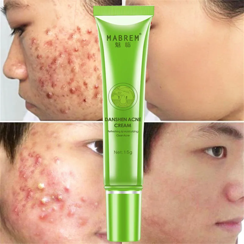 

Danshen Acne Scar Cream Anti Acne Treatment Remove Dark Spots Pimples Oil Control Cleansing Pores Moisturizing Whitening Cream