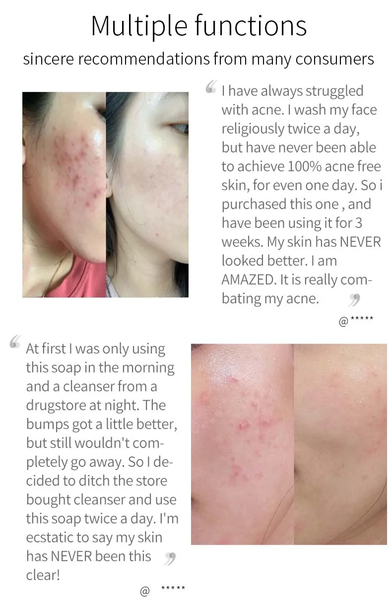 2 piezas de jabón de cúrcuma para limpieza facial, antiacné, blanqueamiento de la piel, eliminación de espinillas, manchas oscuras, jabón hecho a mano_voghion.com