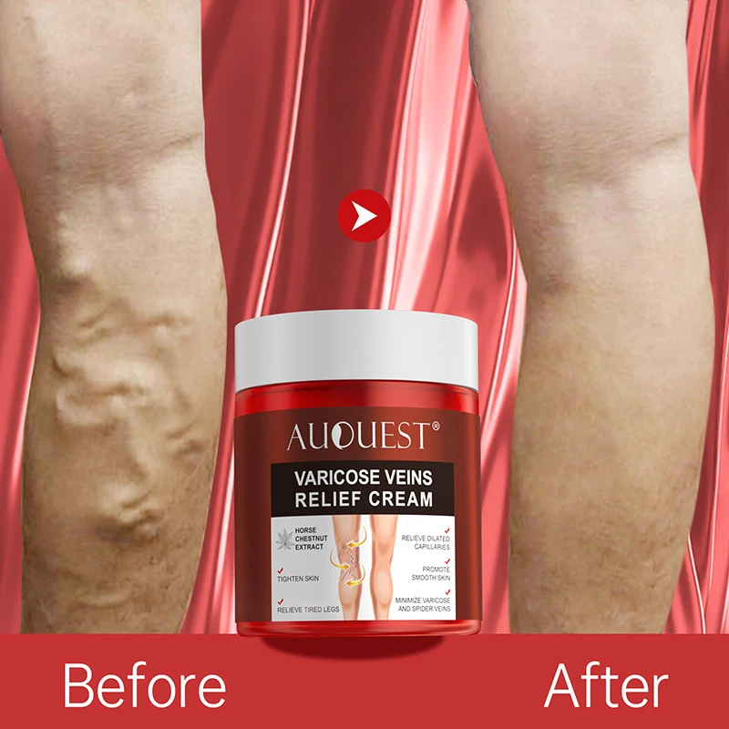 Effective Varicose Veins Relief Cream Relieve Vasculitis Phlebitis