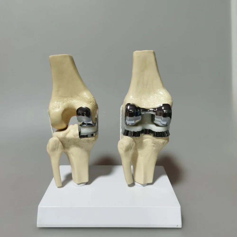 Detachable Artificial Knee Prosthesis Model Small Double Silver Knee Joint Implant Model Set