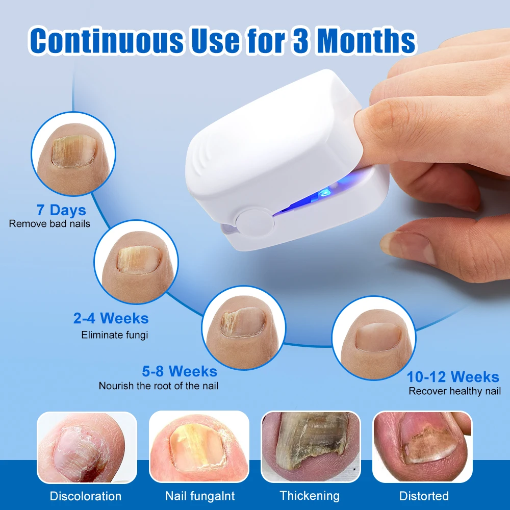 Nail Fungus Remover Nail Fungus Laser Treatment Device Repair Toenail Fingernail Fungus Treat Onychomycosis Laser Nails with Mushrooms Relaxation Laser Therapy Pen