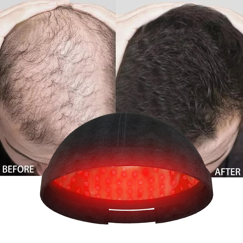 Red Light Therapy Hair Growth Cap 118pcs Lamp Beads 630nm 460nm Laser