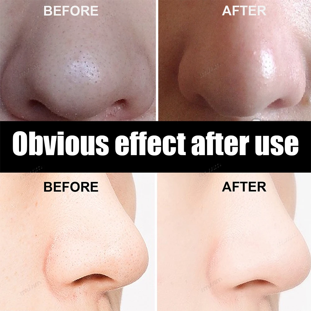Unisex Blackhead Remove Mask Peel Nasal Strips Deep Shrink Cleansing Pore Nose Black Head Remove Stickers Skin Care Mask Patch 3