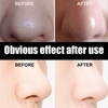 Unisex Blackhead Remove Mask Peel Nasal Strips Deep Shrink Cleansing Pore Nose Black Head Remove Stickers Skin Care Mask Patch 3