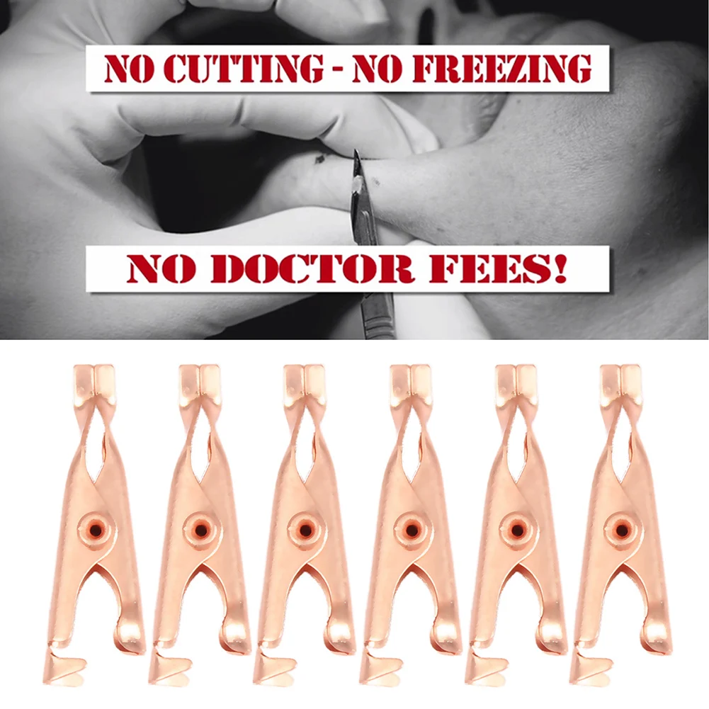 Painless Skin Tag Mole Wart Spot Removal Clips Body Warts Treatment Safe Foot Corn Removal Skin Care Clips Home Use