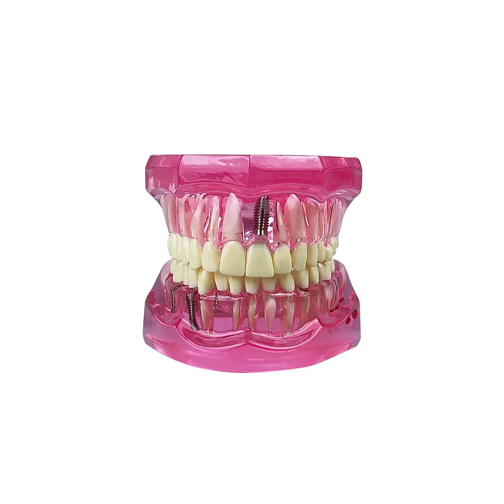 Teeth Repair Model Disease Teeth Model for Dentist Student Practice Training Studying Oral Medical Dentistry Tools