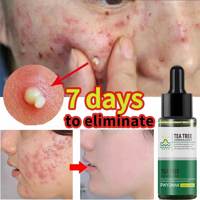 

Tea Tree Anti-Acne Serum Remove Acne Marks Pimples Oil Control Shrink Pores Moisturizing Whitening SkinCare Korean Cosmetics 30g