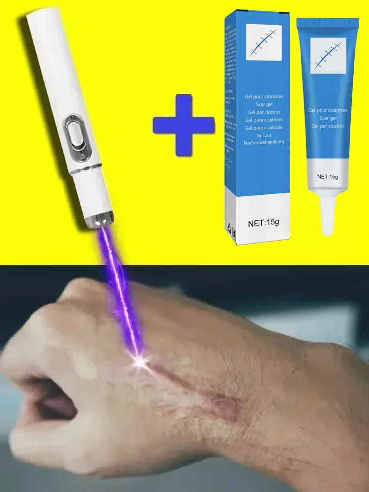 Laser Therapy Keloid Scar Improve Keloid Scar Pen Relief Easy Harmless Laser Pointer