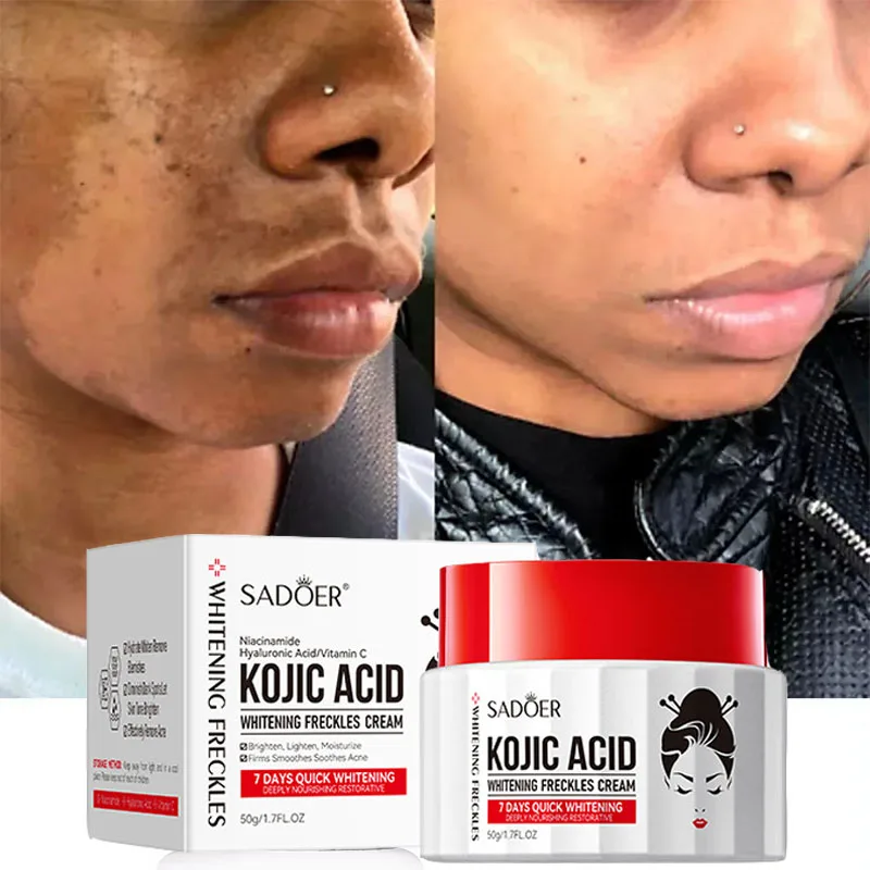 Kojic-Acid-Cream-Remove-Pigment-Melanin-Whitening-Remove-Dark-Spots ...