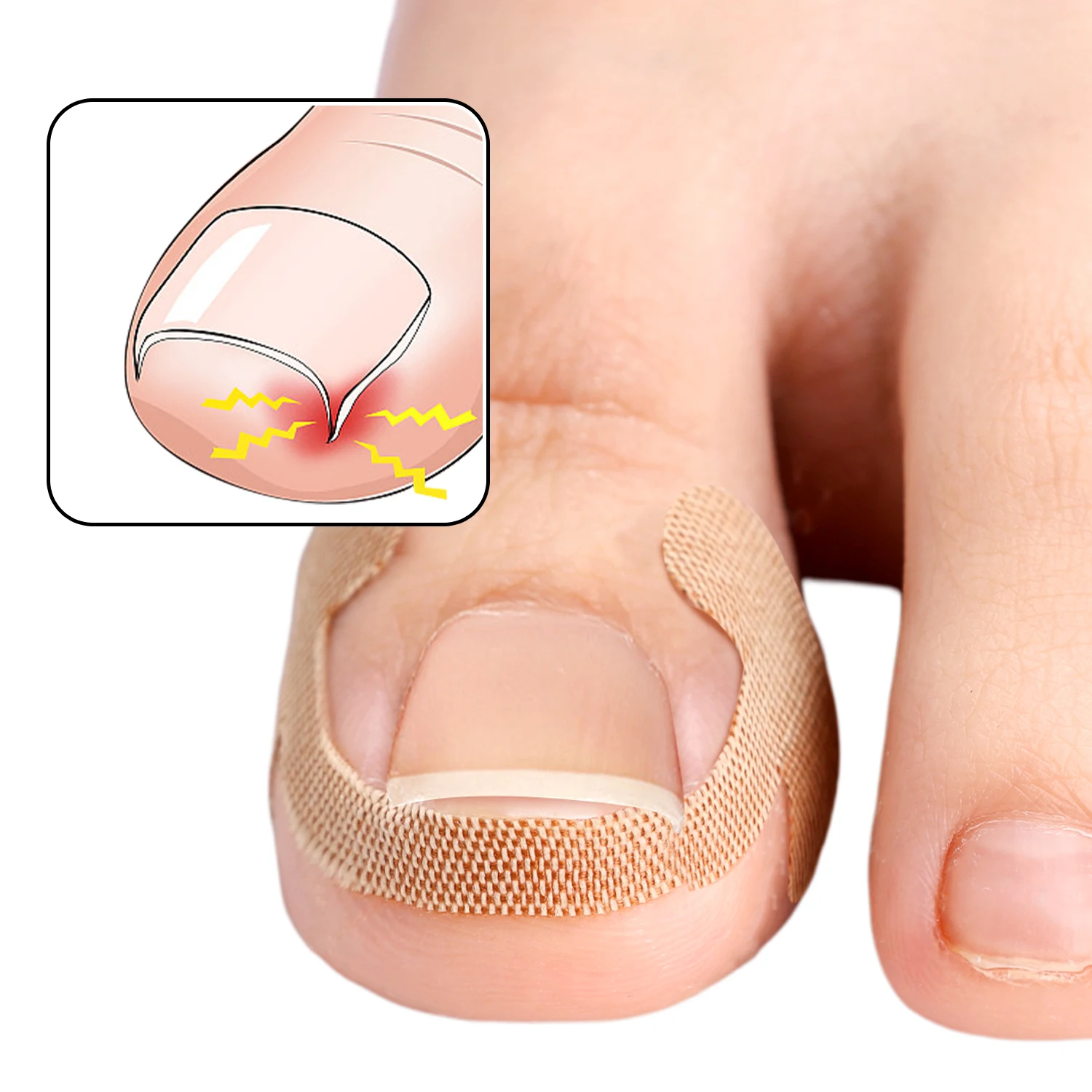 Ingrown Toenail Correction Strips Lasting Adhesion Waterproof Nail Correction Stickers Elasticity Toe Care Pedicure Tools 100pcs