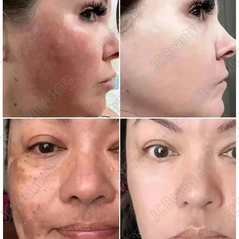 Freckle Whitening Serum Black Dots Melasma Remover Anti Brown Stain Lighten Pigmentation Moisturizing Skin Care Korean Products 2