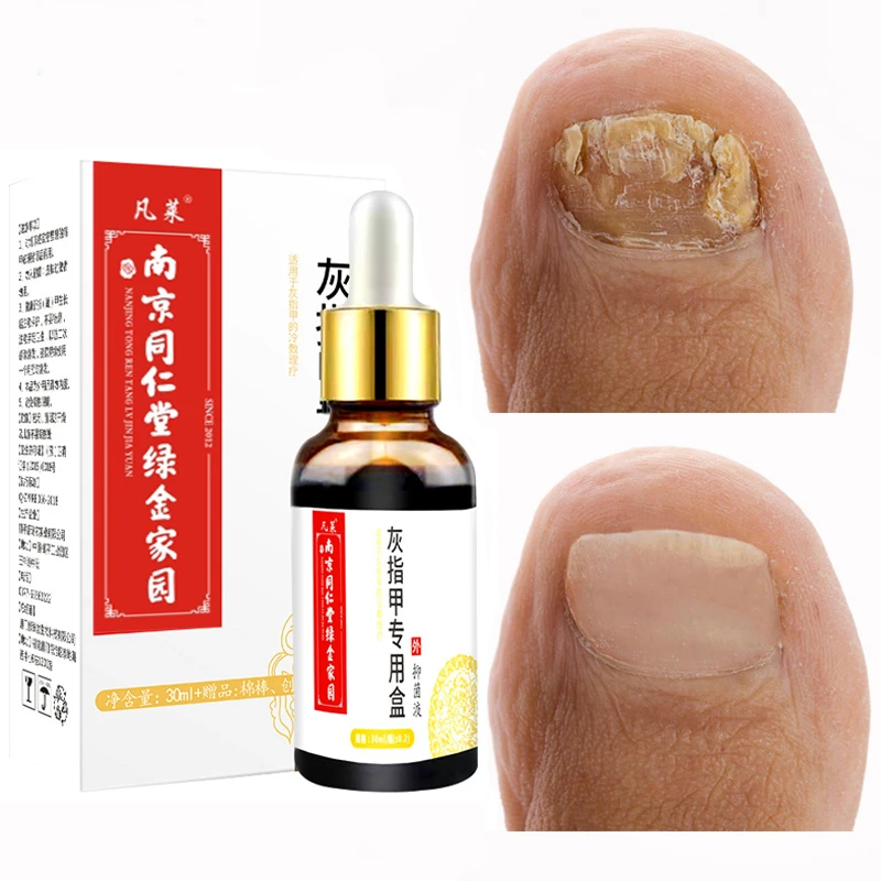 Nail Fungal Treatment Feet Care Essence Anti Infection Paronychia