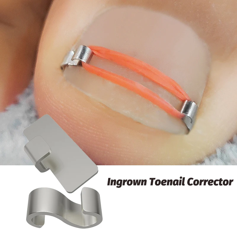 Foot Care Ingrown Toenail Correction Tool Pedicure Treatment Ingrown Toenail Corrector