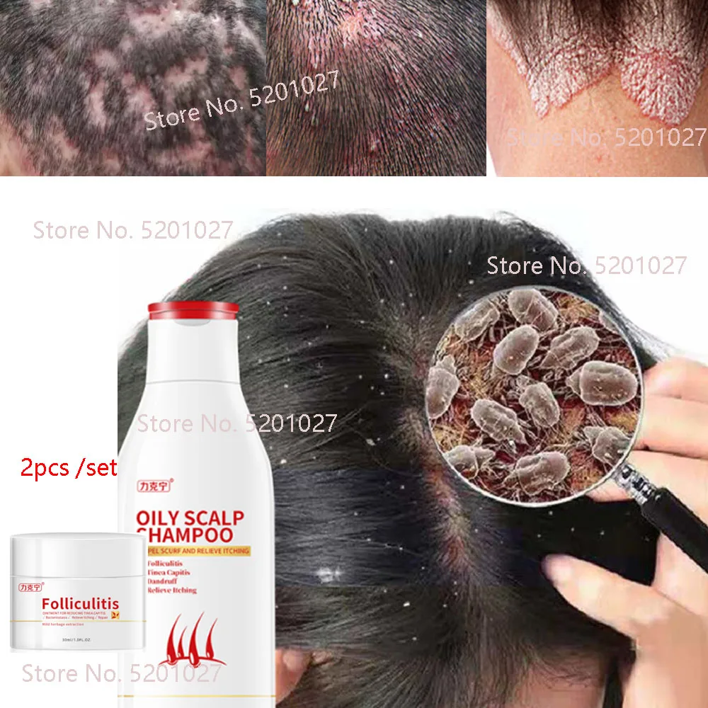 Folliculitis Scalp Stores Online clc.cet.edu