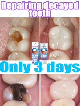 Powerfully repair tooth decay, prevent further tooth corrosion, and protect dental health