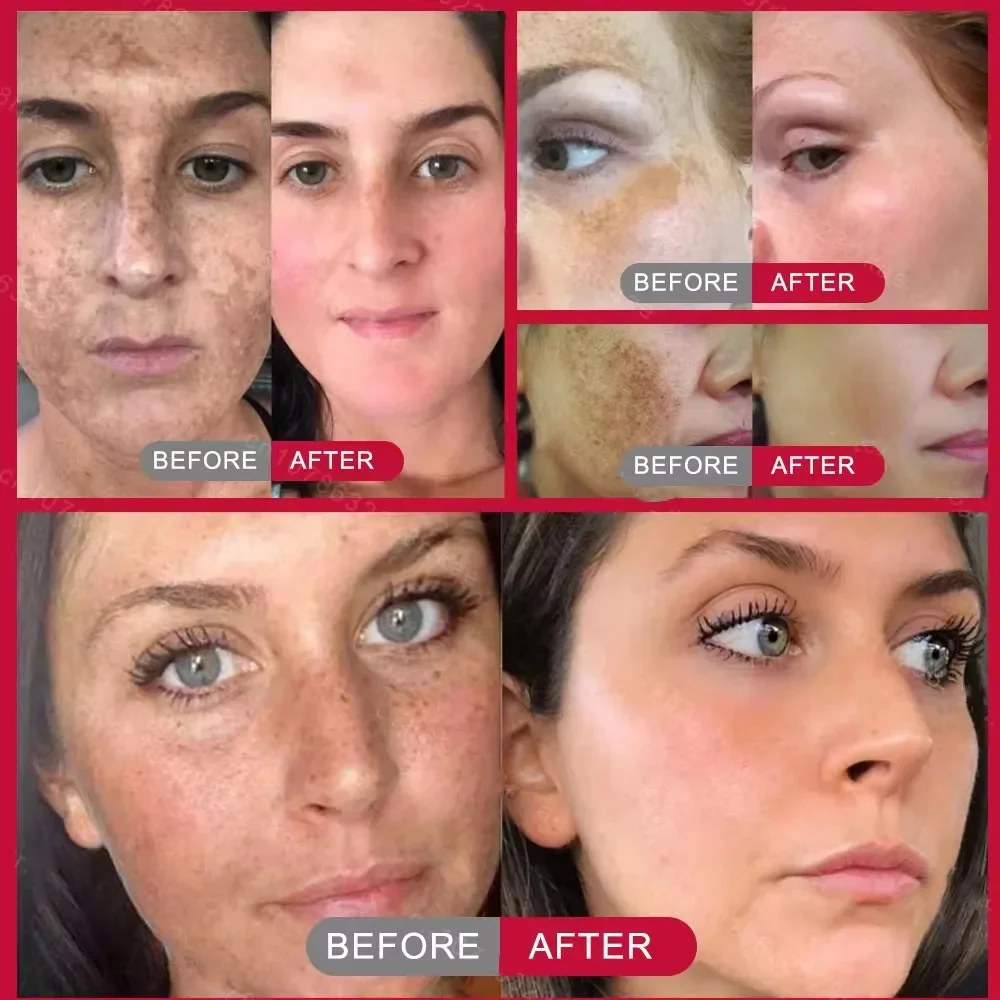 Effective Whitening Cream Freckles Dark Spots Removal Face Brighten Products Fade Melasma Corrector Lighten Melanin Beauty