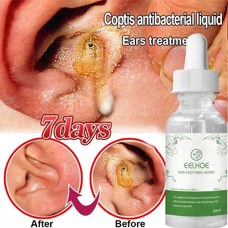 

Tinnitus Ear Drops Effective Treatment Tinnitus Deafness Otitis Hard Hearing Repair Ear Swelling Itching Earache Health Care