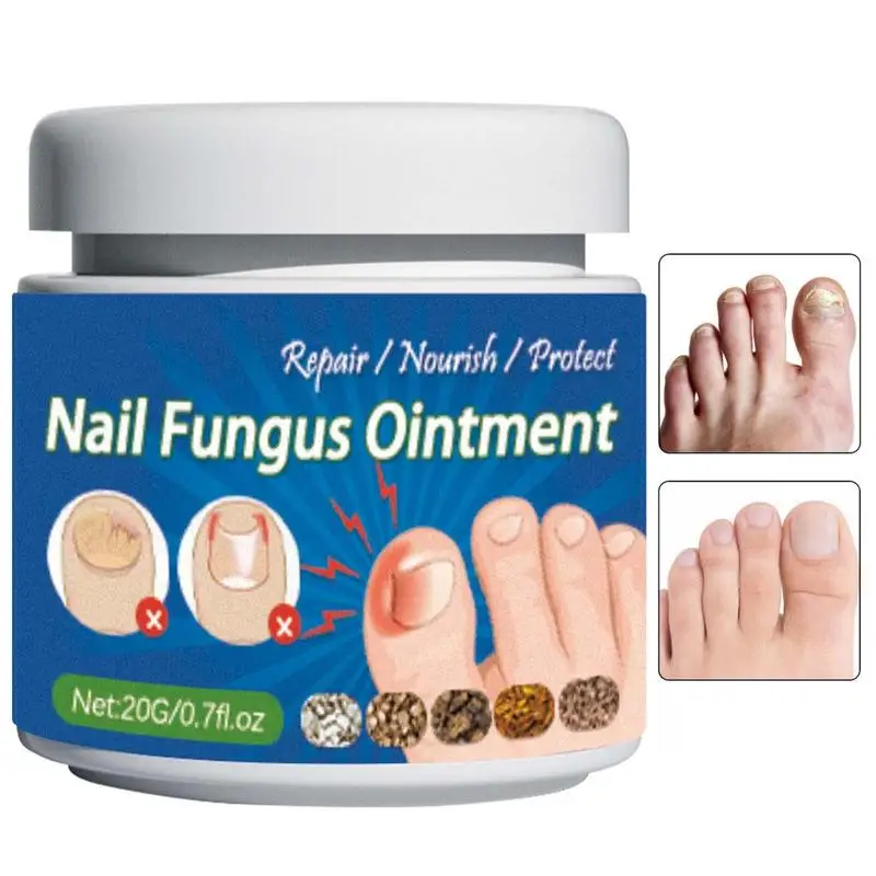 20g Safe Foot Nail Repair Cream Nail Removal Cream Feet Care Cream Toe