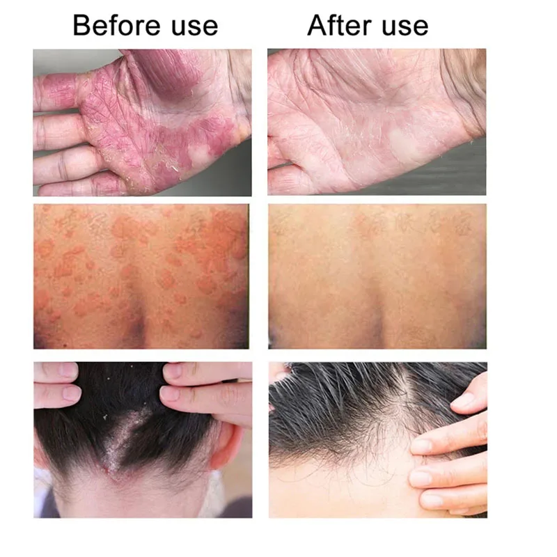 Skin Care Ointment 10g CaoShiFu Eczema Treatment Ointment Antibacterial Psoriasis Cream Anti-Itching Antipruritic Skin Care Herbal Plaster