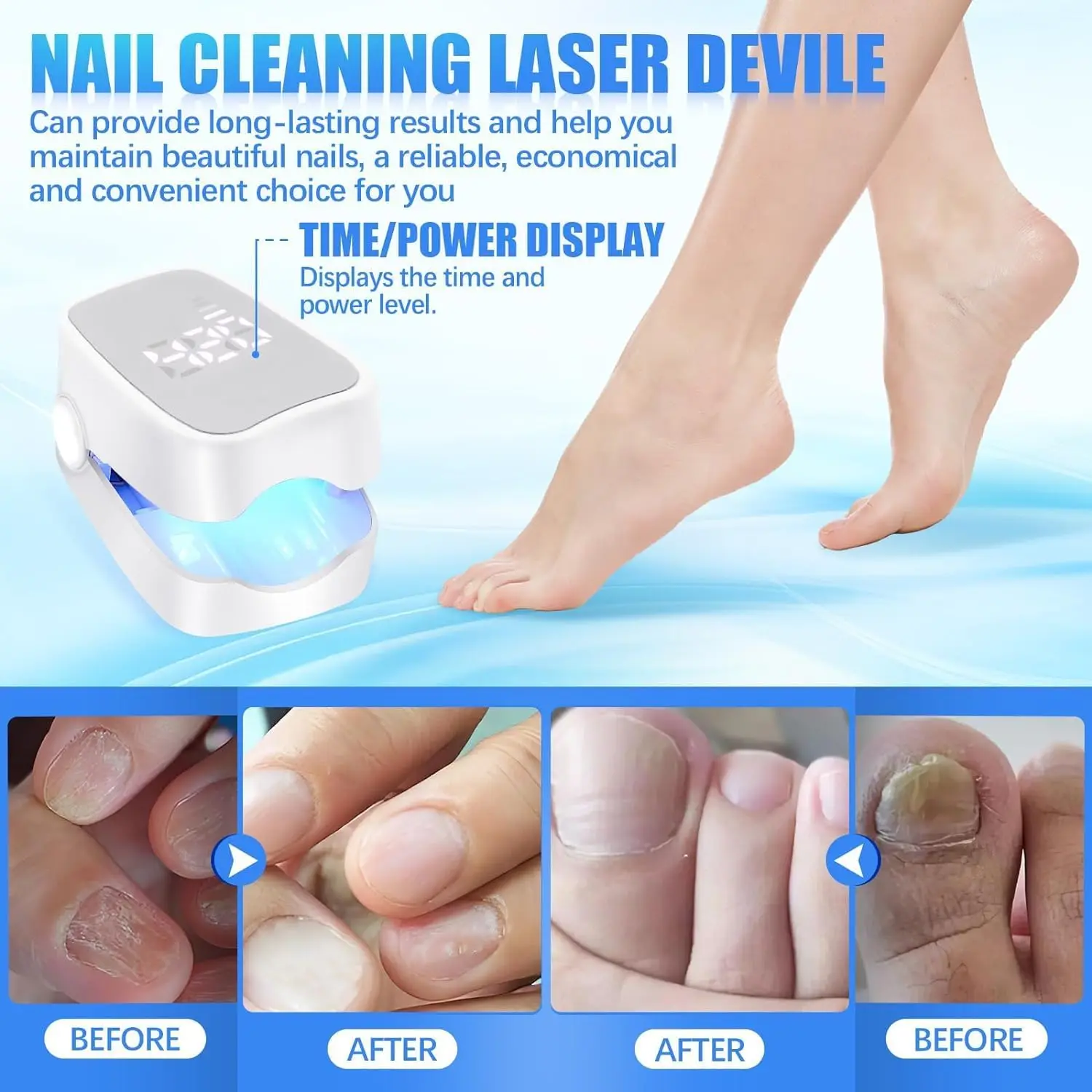Nail Fungus Remover Personal Health Care Laser Therapy Pen Nail Fungus Laser Device with Time Display 470nm950nm wavelength for Finger/Toenails