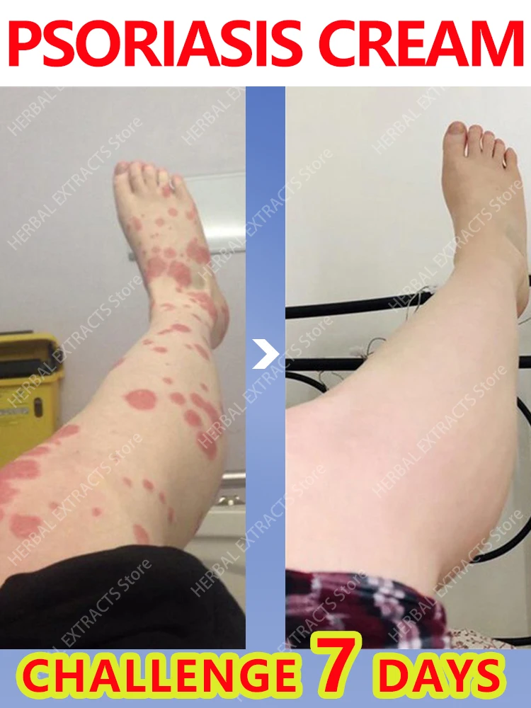 

Psoriasis treatment cream Natural repair Effective antibacterial Relief of itchy skin Moisturizing care for rough skin