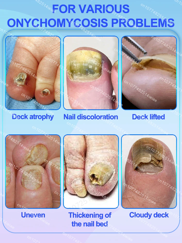 Nail fungus treatment essential oil repair onychomycosis in 7 days