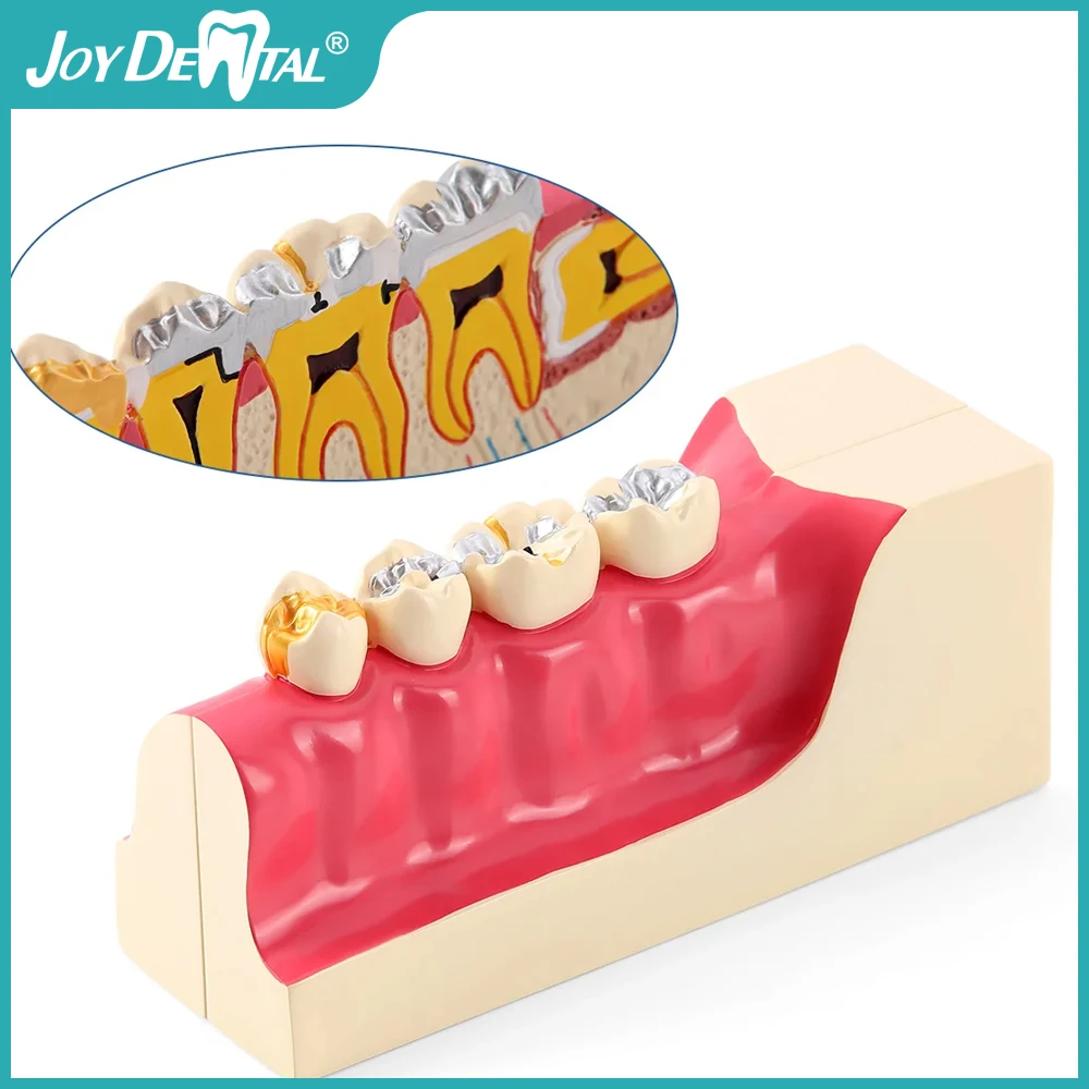 

JOY DENTAL Dental Teaching Model Right lower posterior dental tissue decomposition model communication model with Magnetic