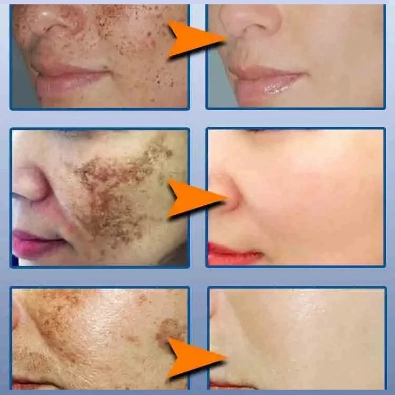 Whitening Body Cream Effective Whitening Freckle Cream Remove Dark Spot Lotion Removal Melanin Melasma Lighten Brighten Anti-Aging Skin Care Products,facial cream
