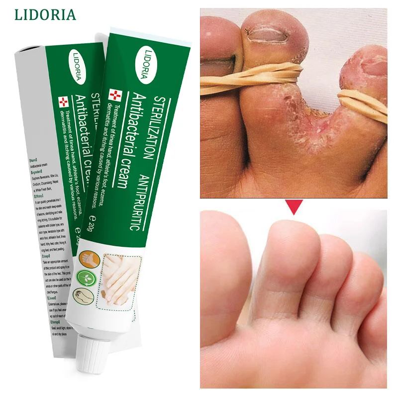 Herbal Anti Fungal Foot Treatment Relieve Beriberi Cream Nail Fungus Removal  Infection Onychomycosis Toe Ointment Feet Care 20g - Feet Care - AliExpress