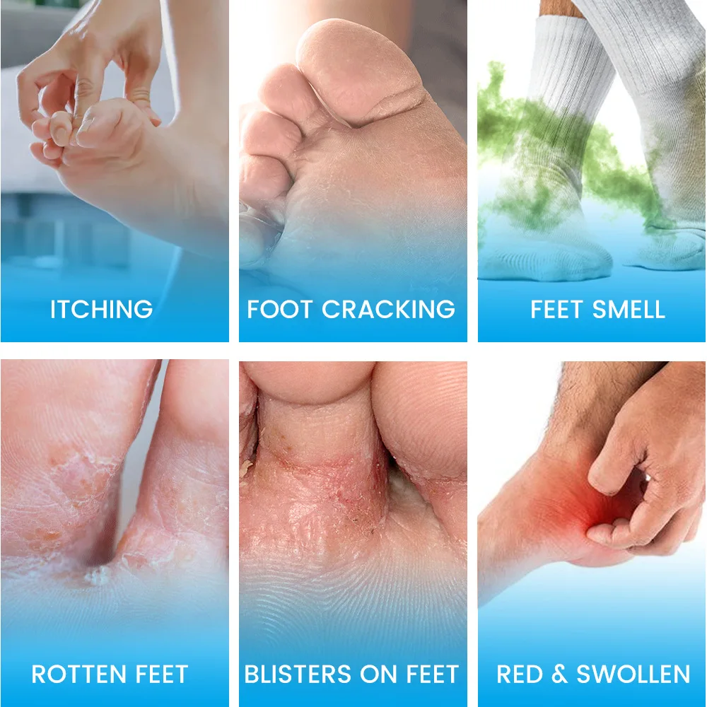 Foot,pedicure,exfoliante para pies pedicure,Tea tree oil and athlete's foot ointment, itchy and smelly feet