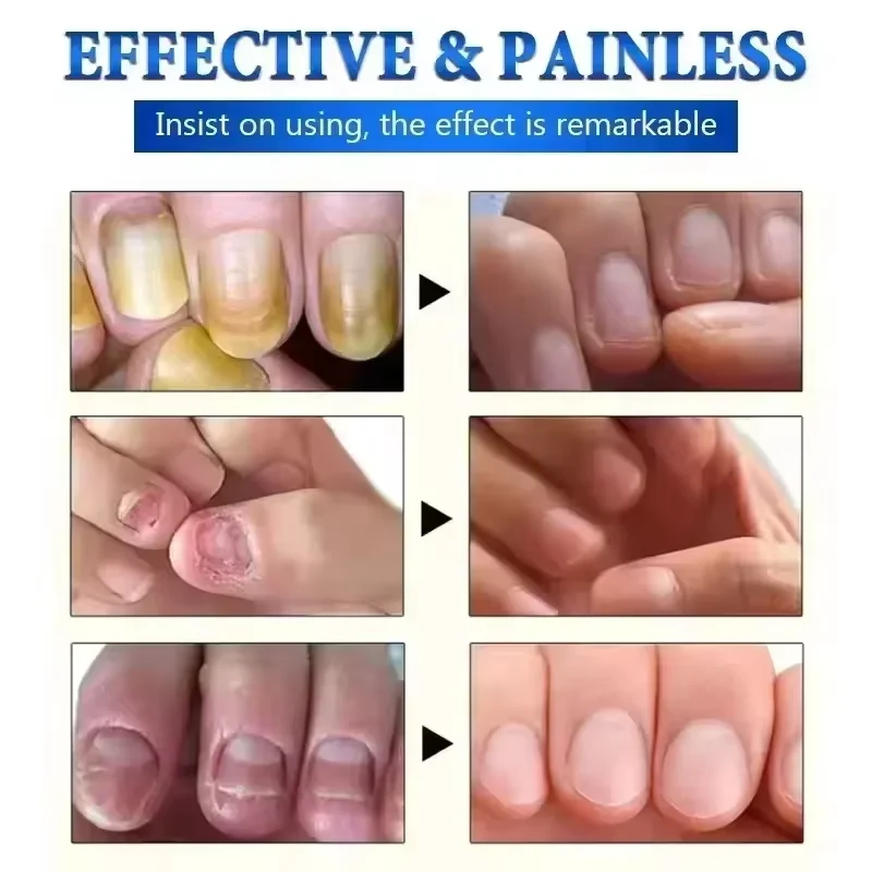 7Days Nail Fungus Treatment Serum Ginger Anti-infective Paronychia Onychomycosis Toe Foot Nail Fungal Repair Gel Hand Foot Care nail fungus treatment