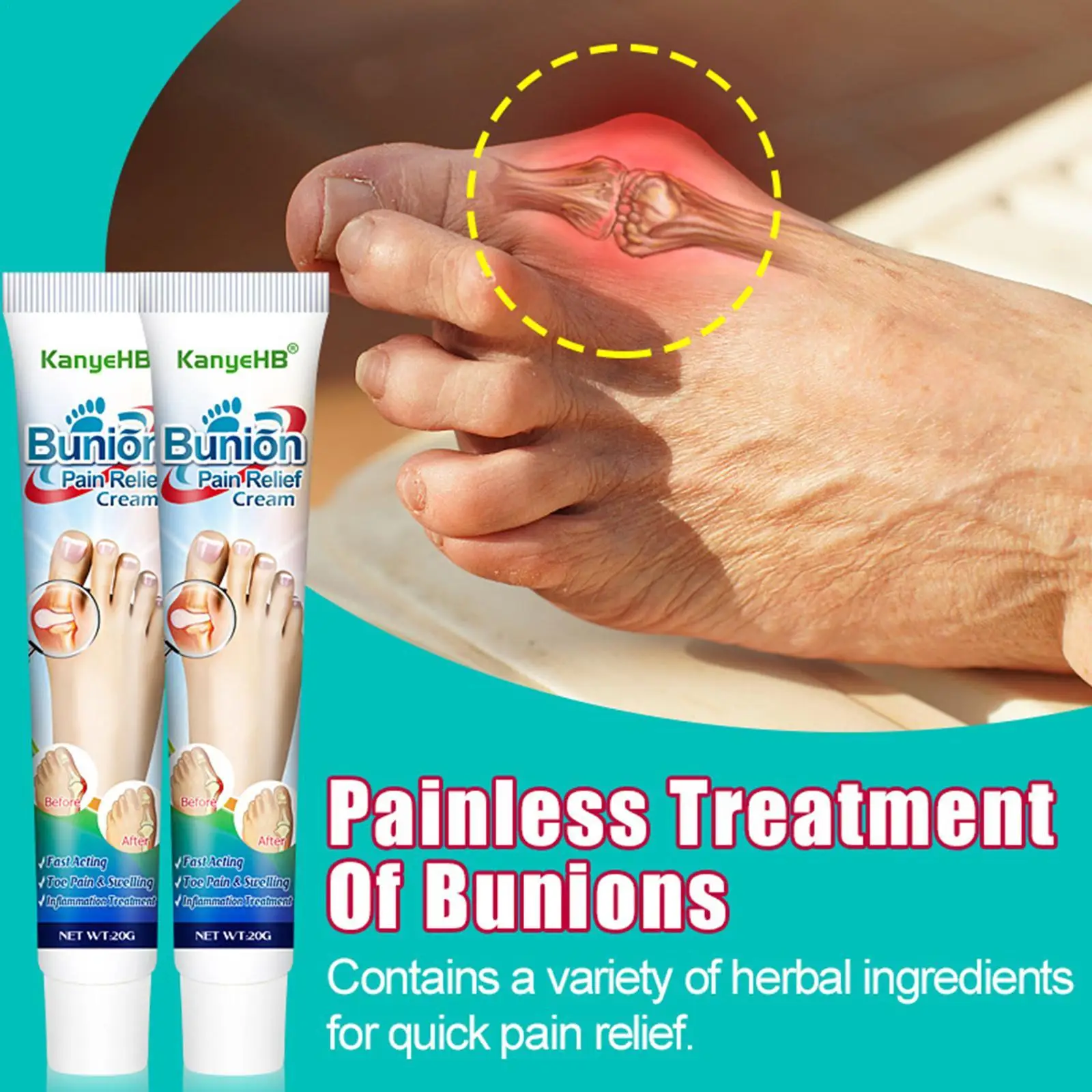 

1Pcs Bunion Treatment Ointment Toe Joint Pain Relief Cream Treat Gout Limb Stiffness Arching Pain Anti-infl 20g