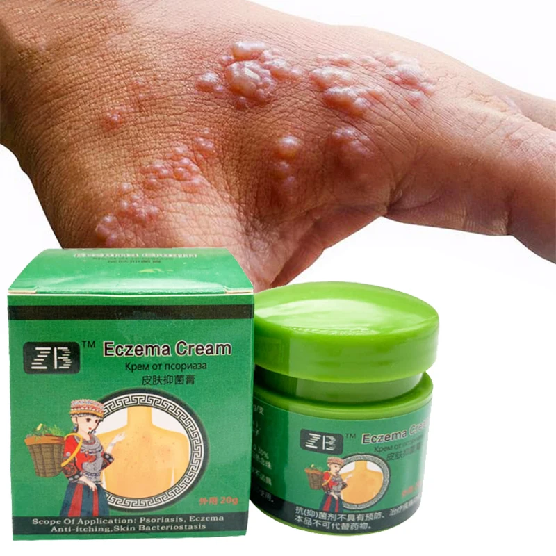 

Sweat Blister Anti-itch Cream Relief Sweat Herpes Ointment Psoriasis Eczema Remove Small Blisters Hand Foot Dry Skin Itchy Care