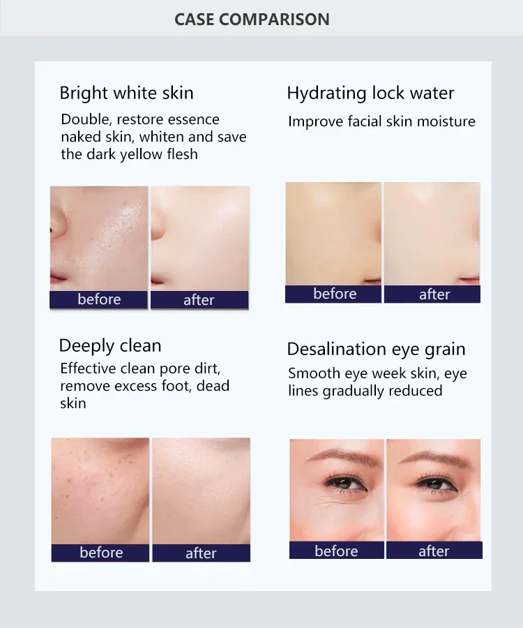 Upgrade your aesthetic services with the AQUA SKIN SMART 9-in-1 facial machine. Featuring hydro dermabrasion, RF, ultrasound, oxygen infusion, and microcurrent technology for deep cleansing, lifting, and skin rejuvenation. Ideal for clinics and beauty salons. AQUA SKIN SMART 9-in-1 Multifunction Facial Machine