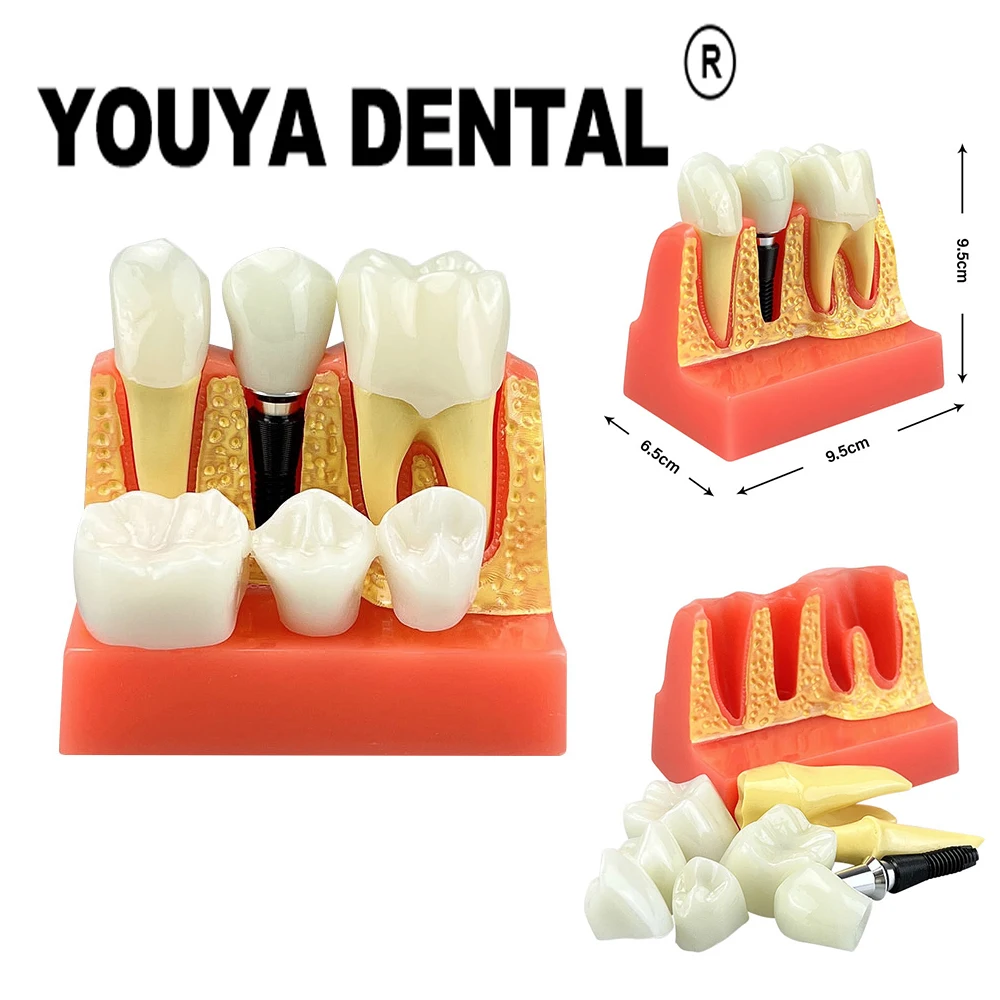 

4-кратная модель имплантации, обучающая модель для стоматолога, демонстрационный модуль для студентов, медицинская научная модель для изучения заболеваний