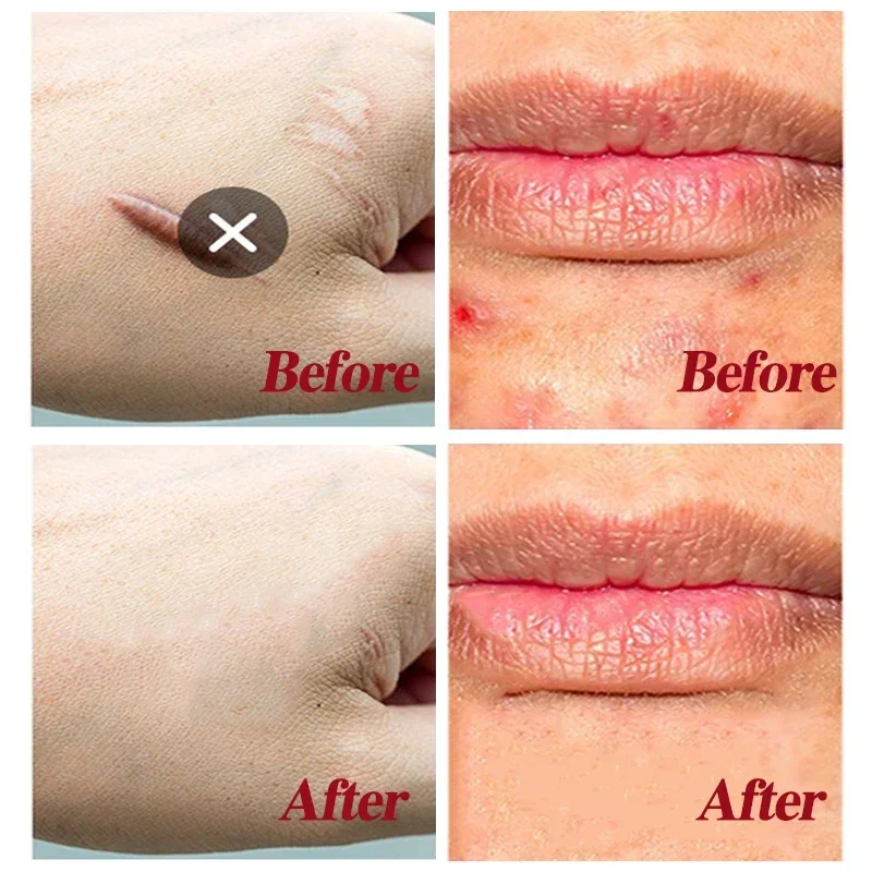 Scar Removal Cream Gel Repaire Pock Mark Burn Surgical Scar Cesarean Stretch Mark Treatment Smooth Moisturize Skin Care 20g