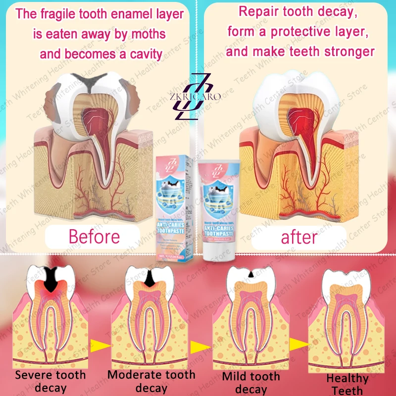 Tooth Decay Repair New Technology Efficient Repair of Tooth Decay