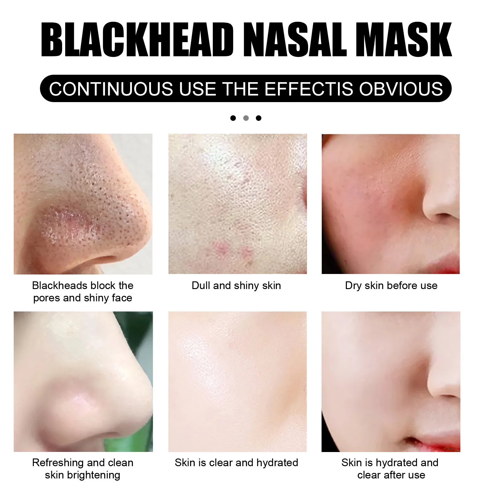 Extreme Blackheads On Nose Youtube - 5qkzfj3