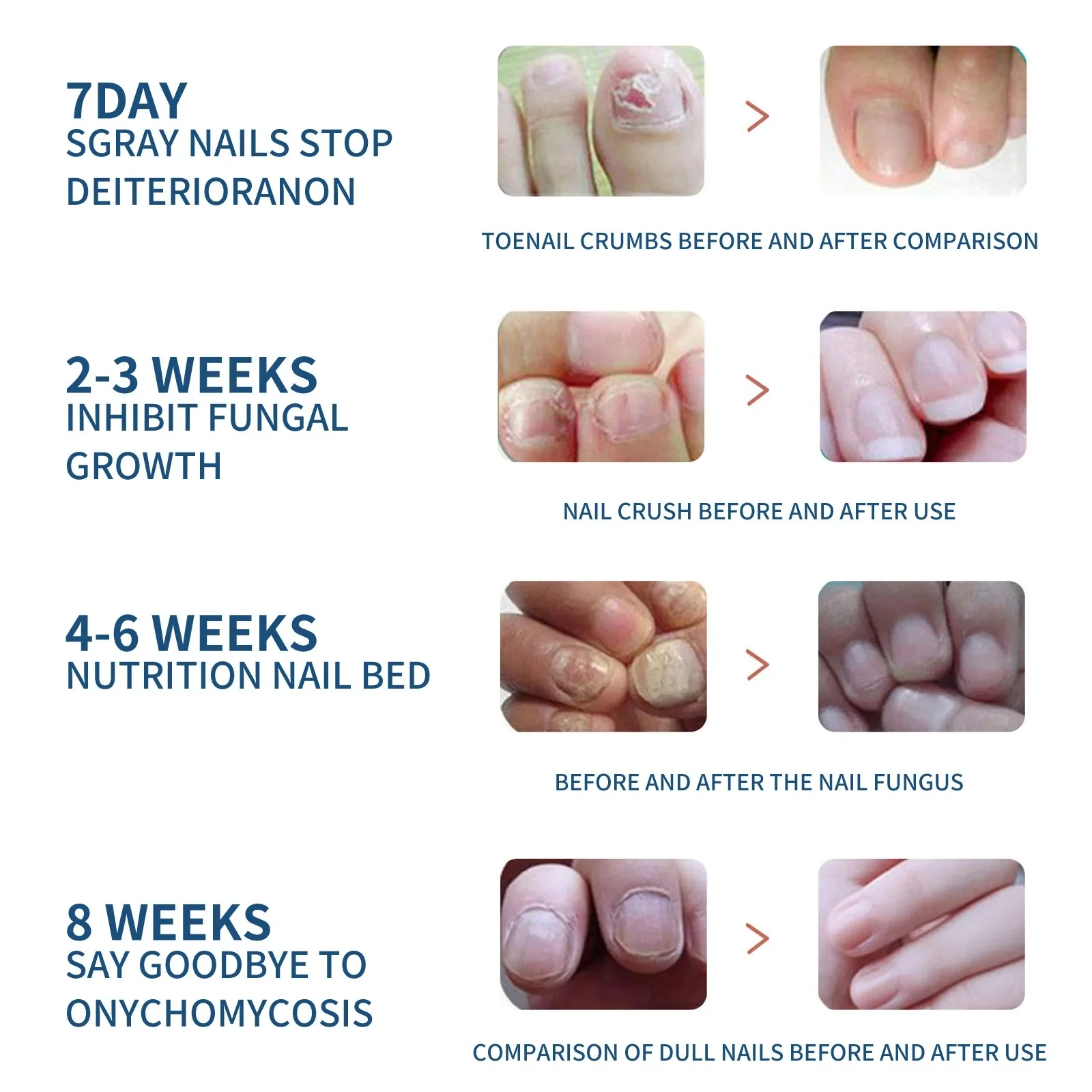 32/96PCS Foot Nail Repair Patch Grey Fungal Nail Thicken Soft Paronychia Infection Hand Nail Correction Sticker Ingrown Toenail